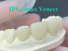 EMAX Veneer, Kalıcı ve Estetik Diş Restorasyonları için Fikir Çözümü