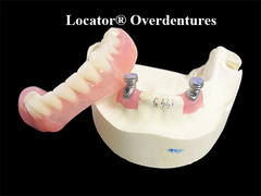 Yerleşimci Overdentures, diş kaybı için optimum istikrar ve tutma sağlamak için tasarlanmıştır.