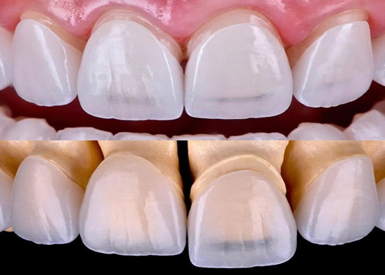 satın al Tüm seramik zirkonyum malzemesi ile üretilen uzun ömürlü diş EMAX kaplama online manufacture