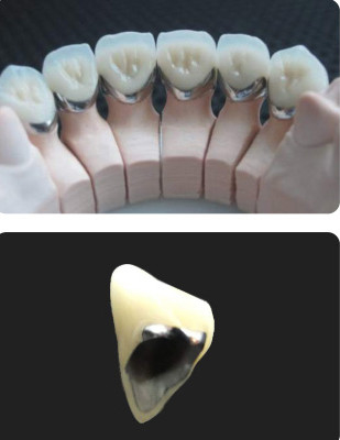 satın al Porselen Metalle Erimiş PFM Taç Restoratif Diş Hekimliği için Diş Kullanımı Direnci online manufacture