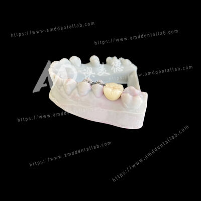 satın al PFM Maryland Köprüsü Bir Pontic İki Kanat Muhafazakar ve Estetik Bir Çözüm online manufacture