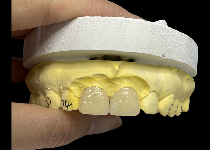 Porselen Gölgesi Ultra İnce EMAX Finerleri Estetik Restorasyonlar İçin leke Direnci