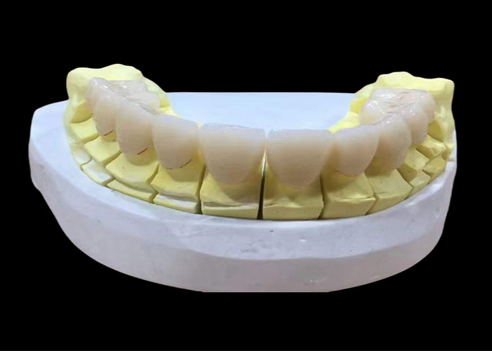 Çin diş laboratuvarından gelen estetik ve doğal görünümlü bitirme ile zirkonya porselen diş tacı