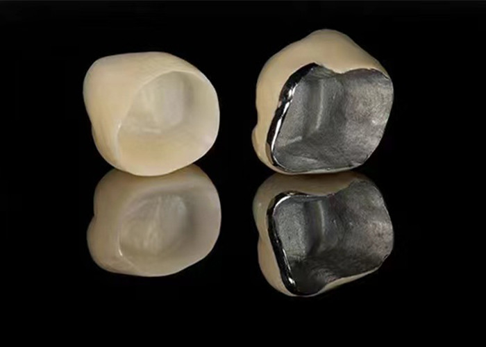 Doğal Görünümlü Porselen, Zararlı Dişleri Yeniden Yapmak İçin Metal Taçla Birleştirildi