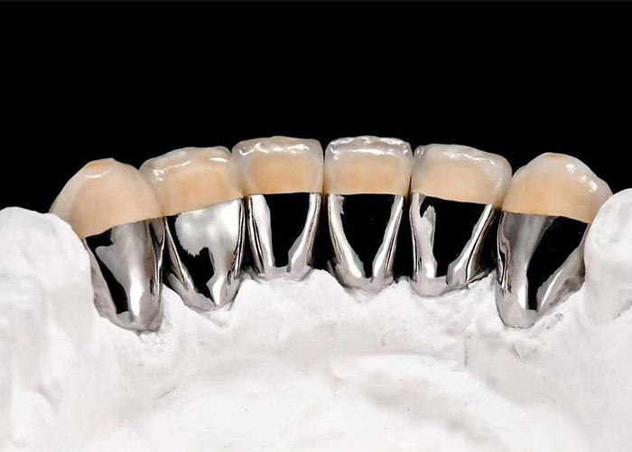 Doğal Görünümlü Porselen, Zararlı Dişleri Yeniden Yapmak İçin Metal Taçla Birleştirildi