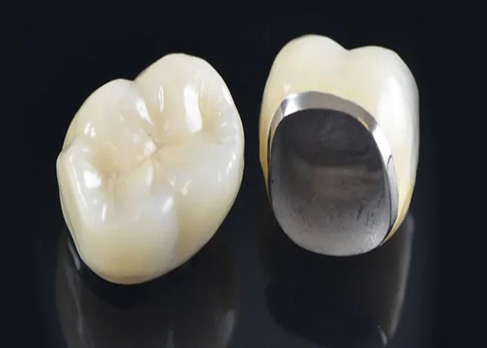 Doğal Görünümlü Porselen, Zararlı Dişleri Yeniden Yapmak İçin Metal Taçla Birleştirildi