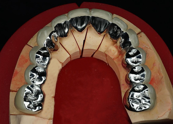 Doğal görünümlü bir gülümseme için metal taçla füzelenmiş yüksek dayanıklı restorasyon porselen