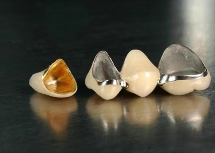 Doğal görünümlü bir gülümseme için metal taçla füzelenmiş yüksek dayanıklı restorasyon porselen