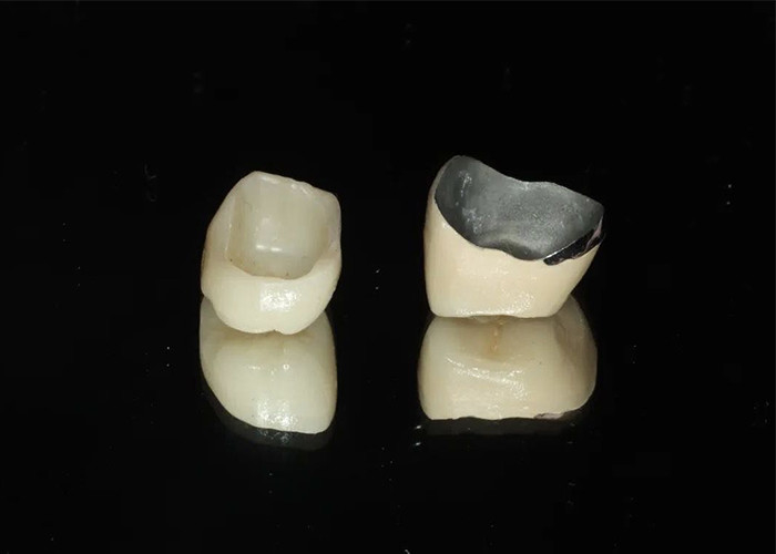 Doğal görünümlü bir gülümseme için metal taçla füzelenmiş yüksek dayanıklı restorasyon porselen