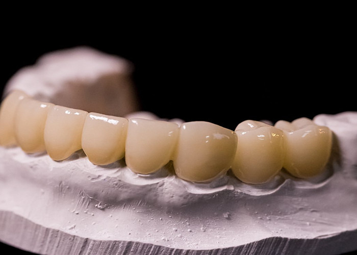 Metal Taçlara Erimiş Porselen - Uzun Süren Gülümsemenin Yenilenmesi İçin Gelişmiş Teknoloji