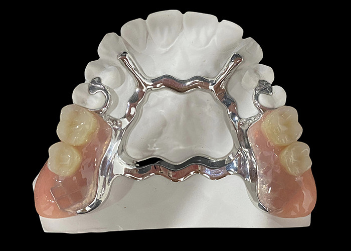 Metal tabanlı ve akrilik reçine kısmi çıkarılabilir diş protezi güvenli bir uyum ve doğal bir görünüm için