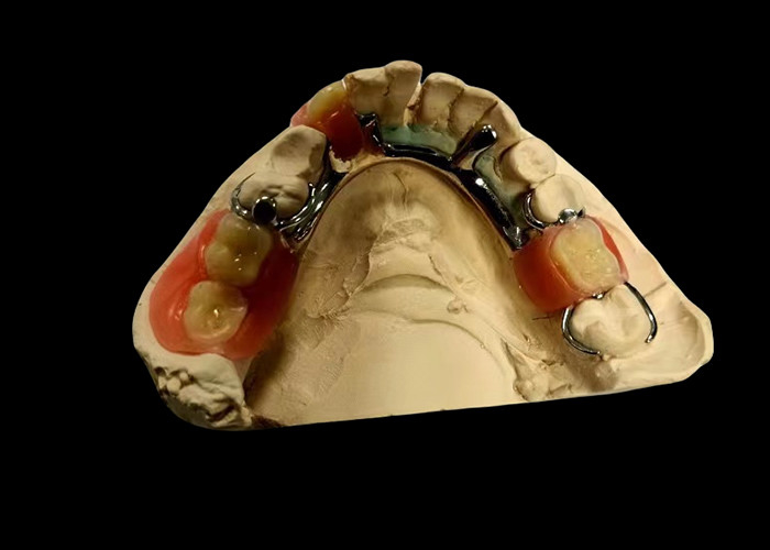 Metal tabanlı ve akrilik reçine kısmi çıkarılabilir diş protezi güvenli bir uyum ve doğal bir görünüm için