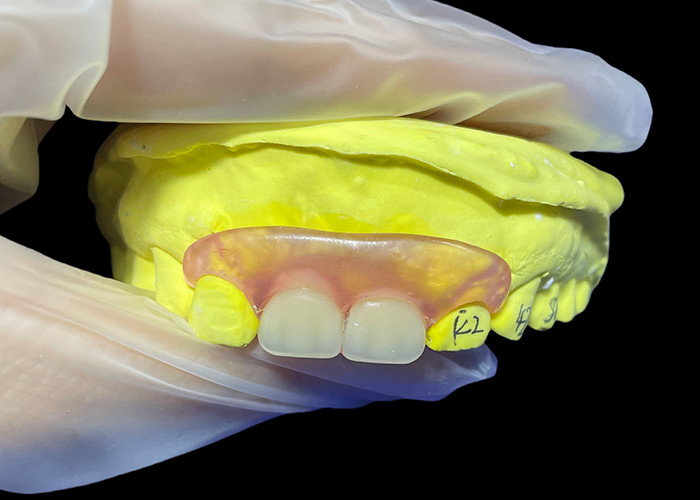 Uyumlu Güvenli Uyumlu Görünmez Esnek Parital Diş Dentisi Konforlu Çiğnemek ve Konuşmak için