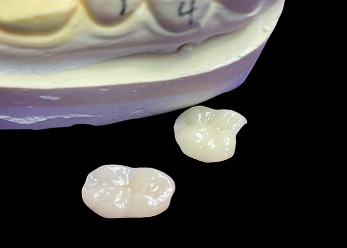 IPS e.max Molar Restorasyonu için Keramik İnlaylar ve Onlaylar Uzun süreli sonuçlar için doğal estetik ve üstün dayanıklılık