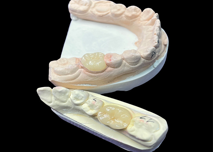 IPS e.max Molar Restorasyonu için Keramik İnlaylar ve Onlaylar Uzun süreli sonuçlar için doğal estetik ve üstün dayanıklılık