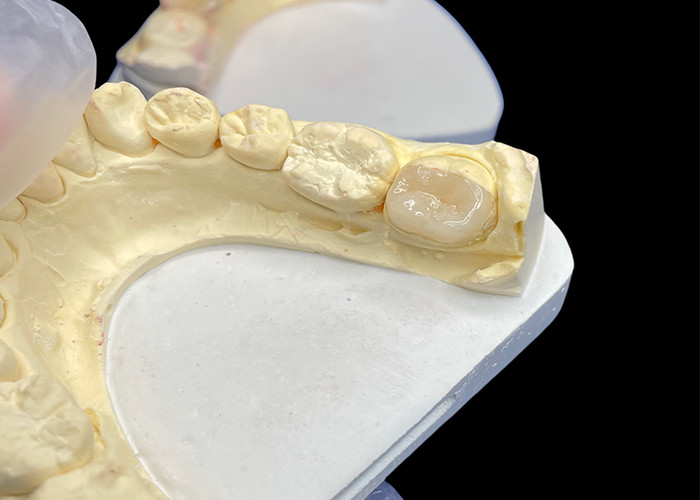 IPS e.max Molar Restorasyonu için Keramik İnlaylar ve Onlaylar Uzun süreli sonuçlar için doğal estetik ve üstün dayanıklılık