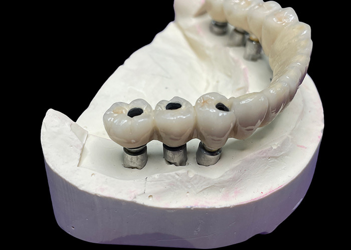 Titanyum tabanlı diş implantı mükemmel bir restorasyon yaratmak için güzel bir seramik taç köprüsü ile üstlendi.