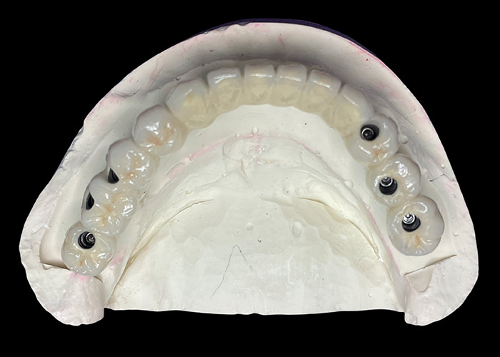 Titanyum tabanlı diş implantı mükemmel bir restorasyon yaratmak için güzel bir seramik taç köprüsü ile üstlendi.