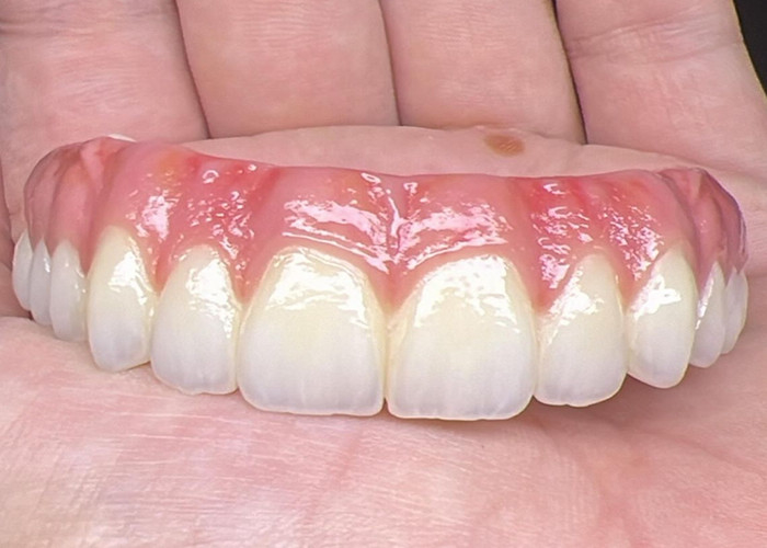 Ağız Sağlığı Diş implantı Desteklenmiş protezler Köprü cilalanmış yüzey Desteklenmiş tam protezler