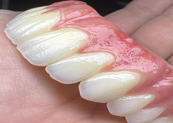 Ağız Sağlığı Diş implantı Desteklenmiş protezler Köprü cilalanmış yüzey Desteklenmiş tam protezler