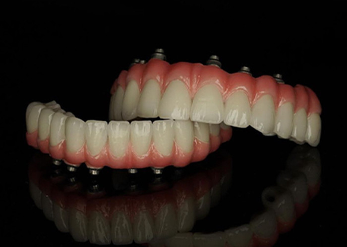 Titanyum tabanlı sabit implant desteklenmiş protezler, eksik dişleri değiştirmek için Keramik Taç Köprüsü ile