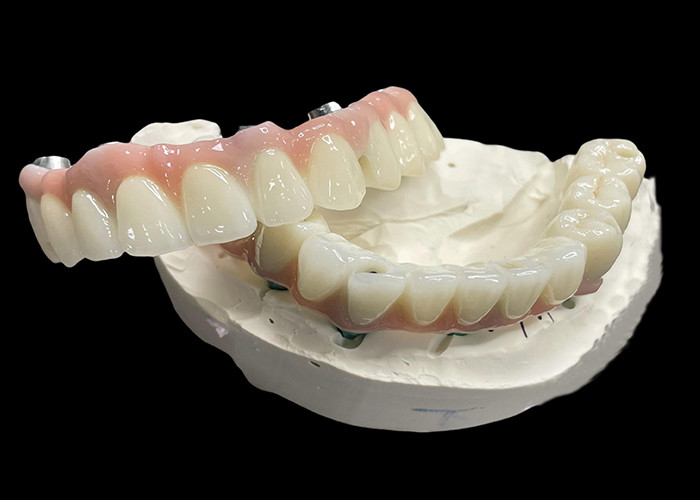 Titanyum tabanlı sabit implant desteklenmiş protezler, eksik dişleri değiştirmek için Keramik Taç Köprüsü ile