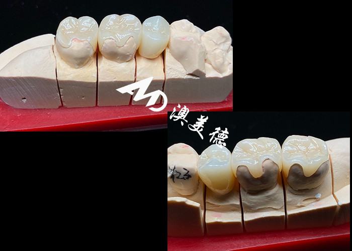 OEM Precision Fit Keramik Inlays Üstün Güç ve Güvenilirlikle Dayanıklı ve Doğal Görünümlü Diş Restorasyonları için Onlays