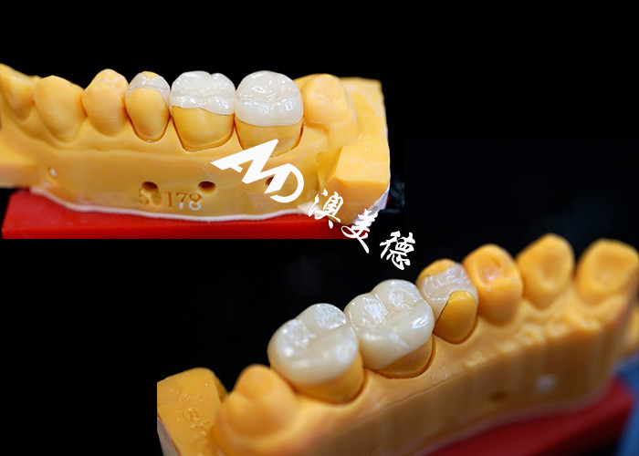 OEM Precision Fit Keramik Inlays Üstün Güç ve Güvenilirlikle Dayanıklı ve Doğal Görünümlü Diş Restorasyonları için Onlays