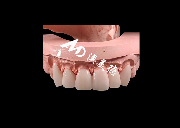 Kozmetik Diş Hekimliği EMAX Estetik Restorasyonlar İçin 0.3-0.5 mm Kalınlığında Diş Finerleri