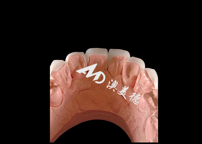 Kozmetik Diş Hekimliği EMAX Estetik Restorasyonlar İçin 0.3-0.5 mm Kalınlığında Diş Finerleri