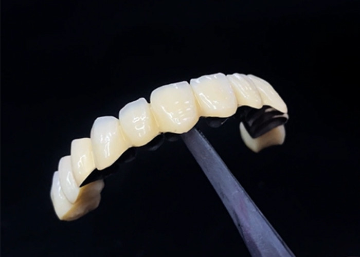 Diş sağlığı için dayanıklılık ve güzelliği birleştiren Metal Taçla Erimiş Porselen
