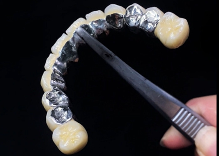 Diş sağlığı için dayanıklılık ve güzelliği birleştiren Metal Taçla Erimiş Porselen