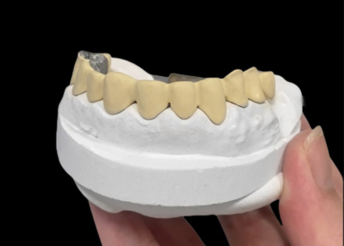 Diş sağlığı için dayanıklılık ve güzelliği birleştiren Metal Taçla Erimiş Porselen