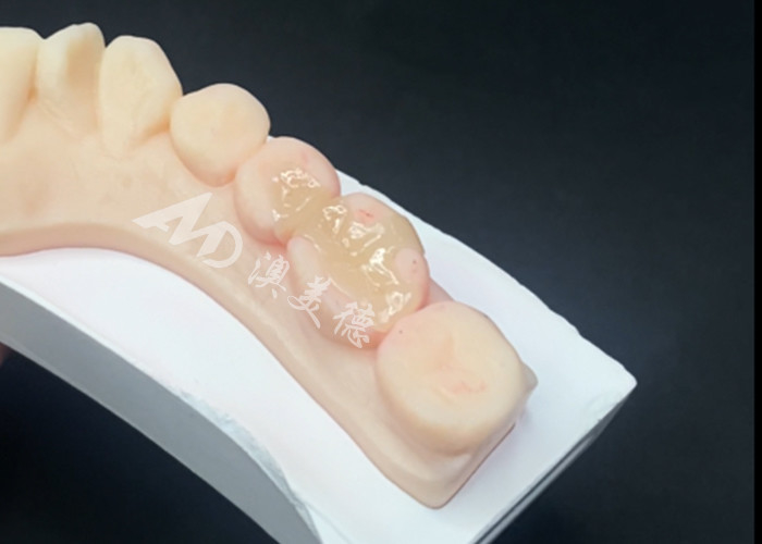 Emax Seramik Inlaylar Doğal Diş Rengi ve Kolay Bakım İçin Diş Restorasyonları