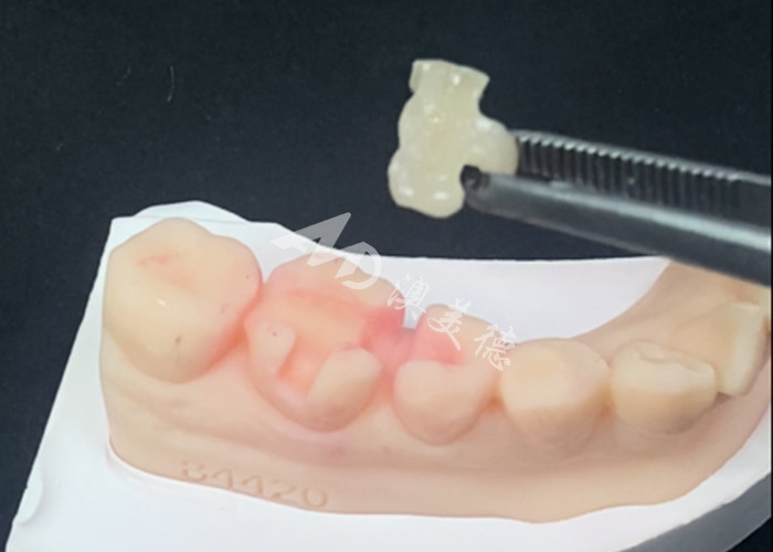 Emax Seramik Inlaylar Doğal Diş Rengi ve Kolay Bakım İçin Diş Restorasyonları