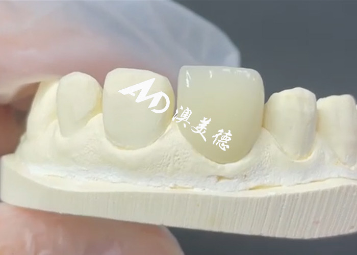 Dayanıklı ve Estetik EMAX Finer Porselen Restorasyonları için Mükemmel Çözüm