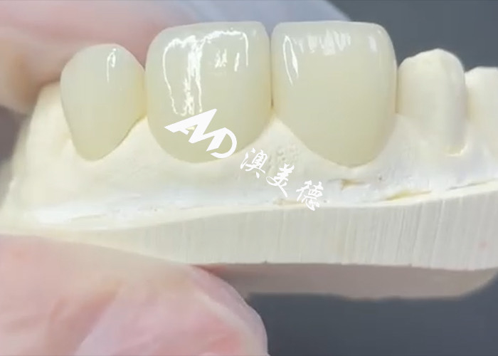 Dayanıklı ve Estetik EMAX Finer Porselen Restorasyonları için Mükemmel Çözüm