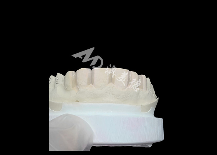 IPS Emax Veneers Minimal Prep/ No-prep Veneers Güzel Gülümsemenin Yenilikçi Çözümleri