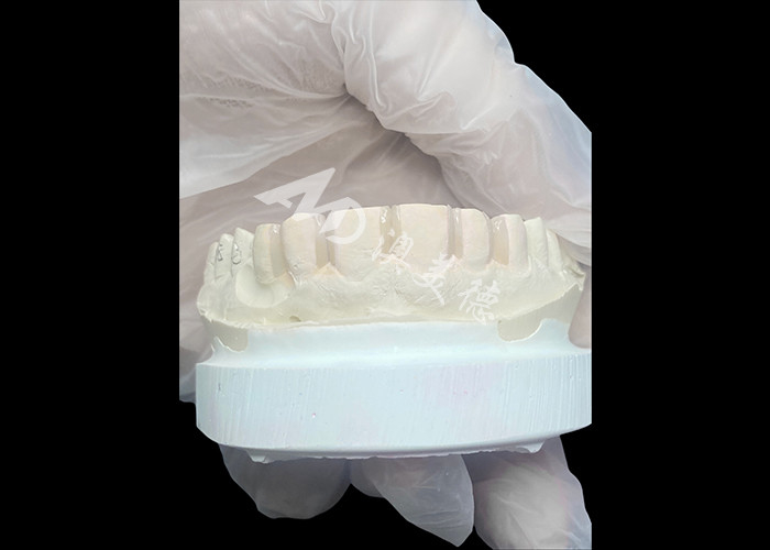 IPS Emax Veneers Minimal Prep/ No-prep Veneers Güzel Gülümsemenin Yenilikçi Çözümleri