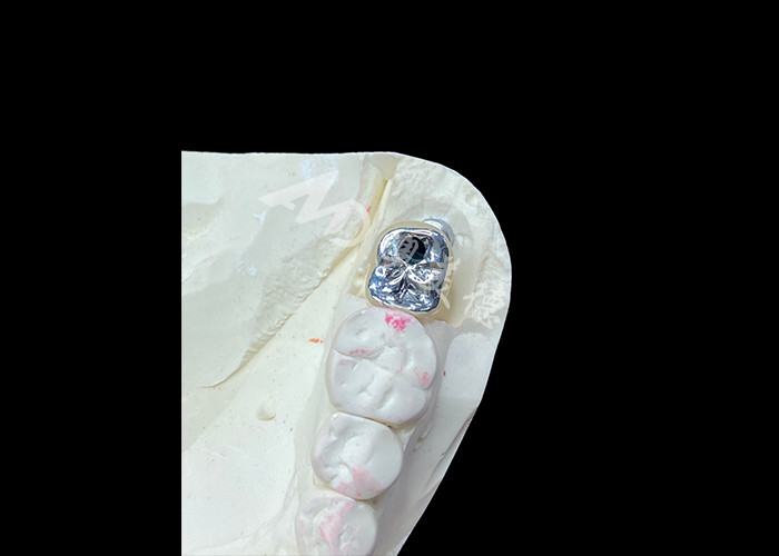 Titanyum Abutmentli Diş İmplantı Tacı ve Porselen-Metal-Fused PFM Tacı
