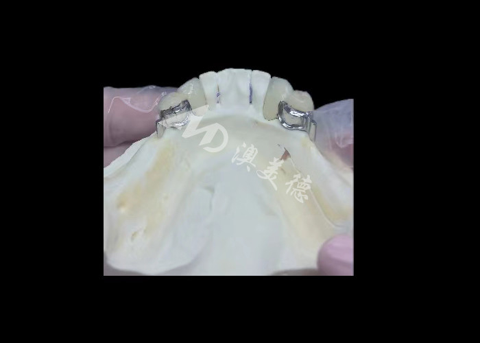 Dayanıklı Porselen Metal Dental Taç PFM Taç Restorasyon için