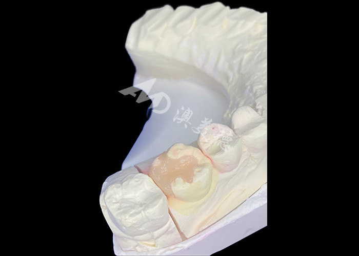 IPS e.max Dayanıklı Estetik ve Doğal Görünüm Sonuçları İçin Molar Restorasyon için Keramik İnlaylar ve Onlaylar