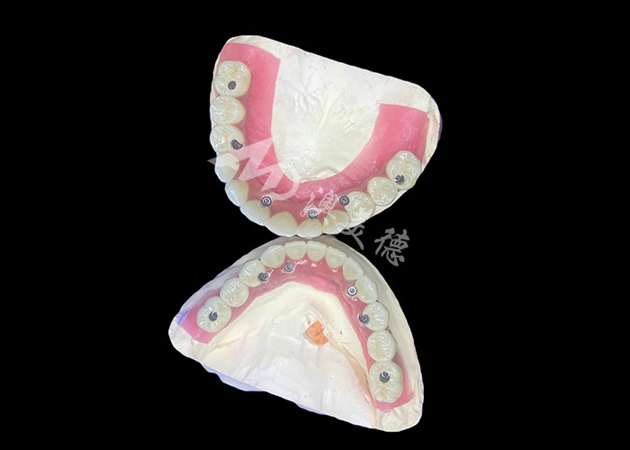 Dental All-on-6 Dental Implant Desteklenmiş Diş Dişleri Dayanıklı ve Rahat