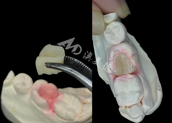IPS e.max Doğal görünümlü diş restorasyonu için seramik inlaylar ve onlaylar