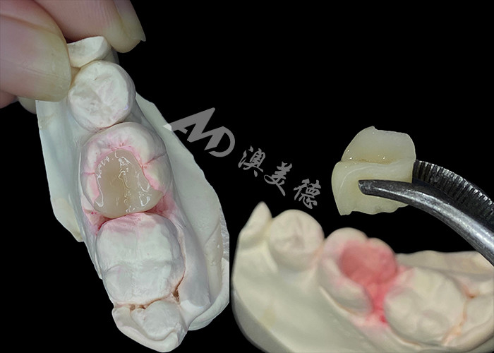 IPS e.max Doğal görünümlü diş restorasyonu için seramik inlaylar ve onlaylar