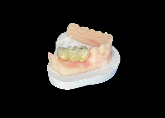 PFM Diş Taçları Optimal Ağız Sağlığı İçin Canlı ve Korozyona Dirençli