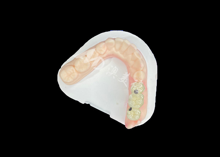PFM Diş Taçları Optimal Ağız Sağlığı İçin Canlı ve Korozyona Dirençli