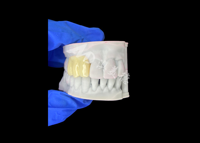 Yumuşak Bio uyumlu 3D basılı Çürük Geçici Köprüsü İmplant öncesi Restorasyonlar için