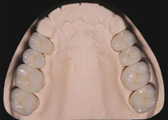 İyi bir fiyat. Diş Restorasyonu Dişler Zirkonya diş taçları çin diş laboratuvarı tarafından üretildi çevrimiçi
