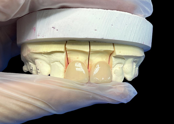 İyi bir fiyat. Doğal görünümlü Estetik Restorasyonlar için hassaslık Güç EMAX Porselen Finer kesici çevrimiçi